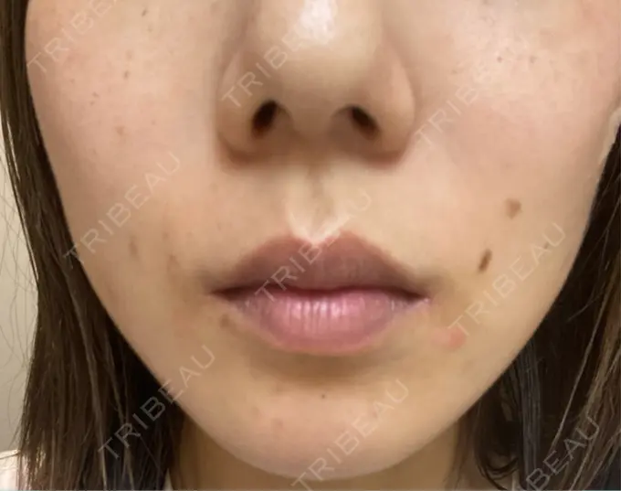 シミ取りレーザー S-Laboクリニック 渋谷院 DAY 2 メイン用