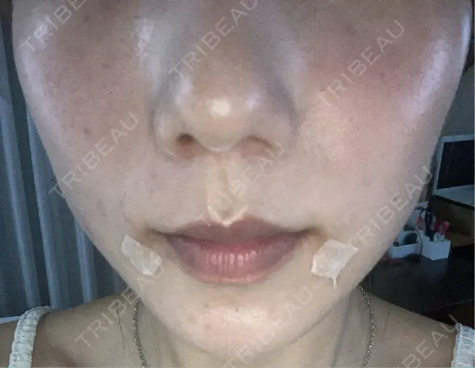 シミ取りレーザー S-Laboクリニック 渋谷院 DAY 5 メイン用