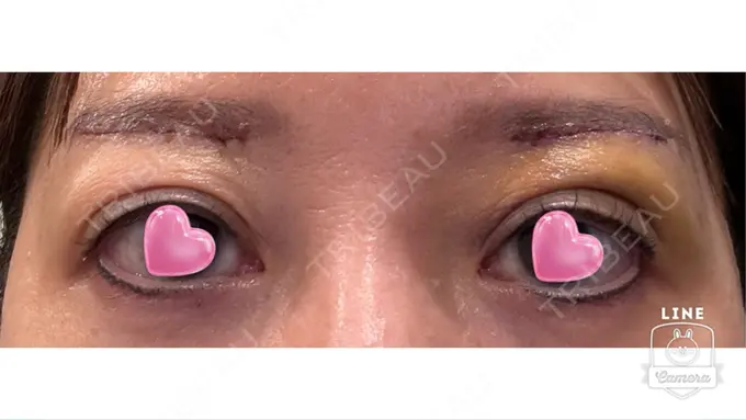 眉下切開 ルーチェクリニック 銀座院 DAY 6 メイン用