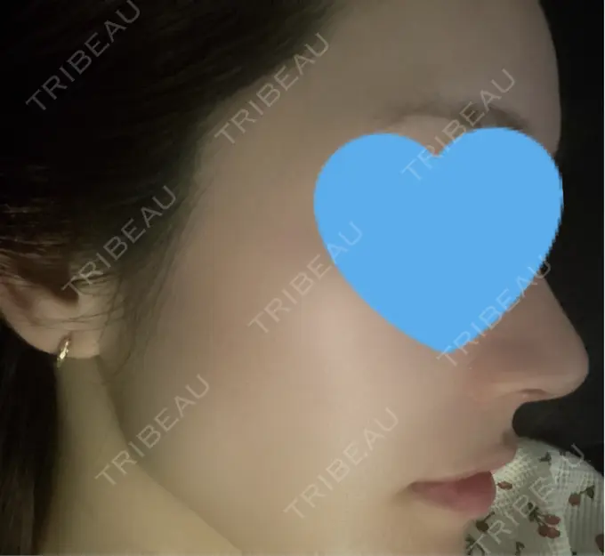 ヒアルロン酸注入（鼻翼基部） DMTC CLINIC 日本橋院 DAY 6 メイン用