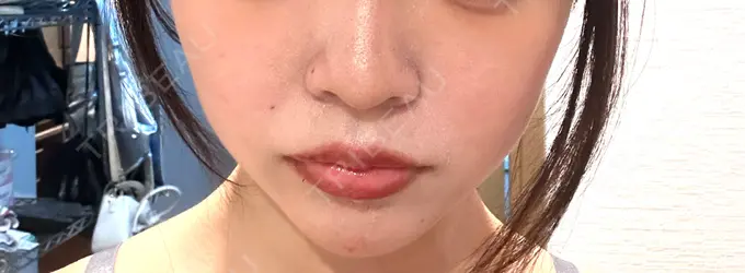 ヒアルロン酸注入（涙袋） / ヒアルロン酸注入（あご） / ボトックス（エラ・小顔） RIVER CLINIC（リバークリニック） DAY 2 メイン用