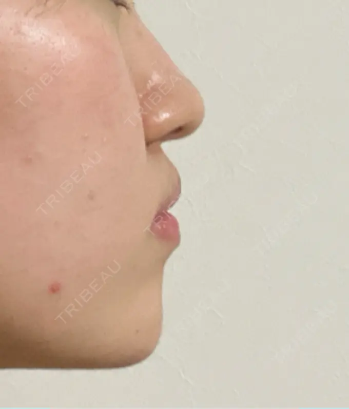 ボトックス（あご） / ボトックス（エラ・小顔） / ボトックス（口角） / ボトックス（人中） / ピーリング（ハリ・ツヤ） 湘南美容クリニック 金山院 DAY 1 メイン用