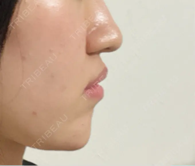 ボトックス（あご） / ボトックス（エラ・小顔） / ボトックス（口角） / ボトックス（人中） / ピーリング（ハリ・ツヤ） 湘南美容クリニック 金山院 DAY 5 メイン用