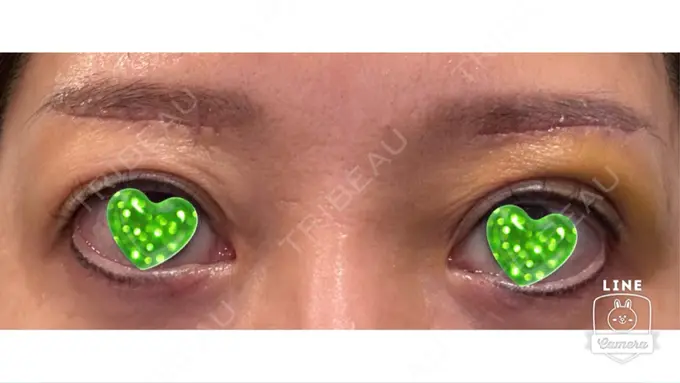 眉下切開 ルーチェクリニック 銀座院 DAY 7 メイン用