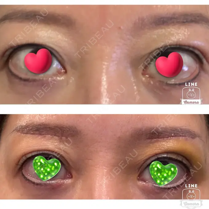 眉下切開 ルーチェクリニック 銀座院 DAY 7 メイン用