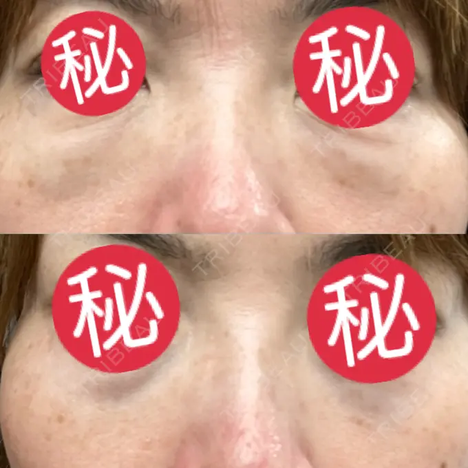 クマ治療 東京形成美容外科 船橋院 DAY 0 メイン用