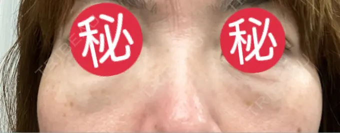 クマ治療 東京形成美容外科 船橋院 DAY 1 メイン用