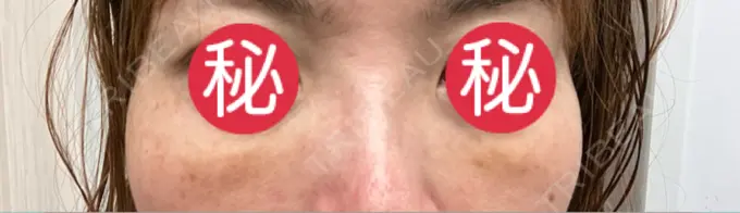 クマ治療 東京形成美容外科 船橋院 DAY 2 メイン用