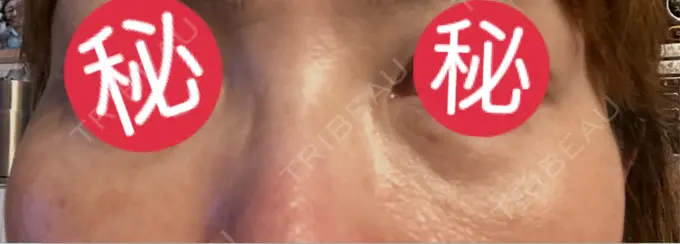 クマ治療 東京形成美容外科 船橋院 DAY 5 メイン用