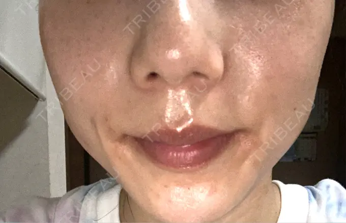 シミ取りレーザー S-Laboクリニック 渋谷院 DAY 6 メイン用