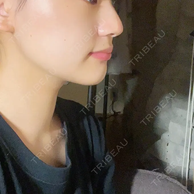 糸リフト / 脂肪吸引（顔） 東京シンデレラ美容外科 大宮院 AFTER メイン用