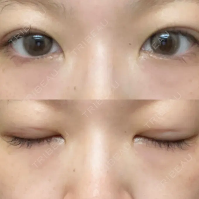 二重埋没 水の森美容クリニック 東京銀座院 DAY 12 メイン用