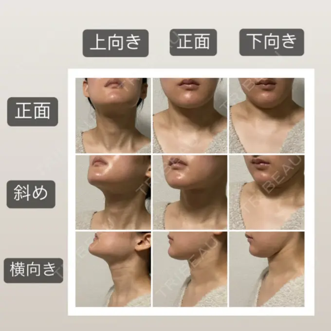 脂肪吸引（顔） 湘南美容クリニック 秋葉原院 AFTER メイン用