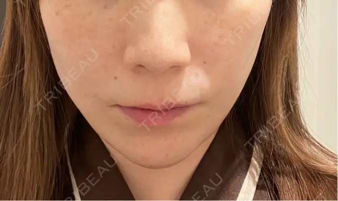 糸リフト / 脂肪吸引（顔） / ボトックス（エラ・小顔） RIVER CLINIC（リバークリニック） DAY 0 メイン用