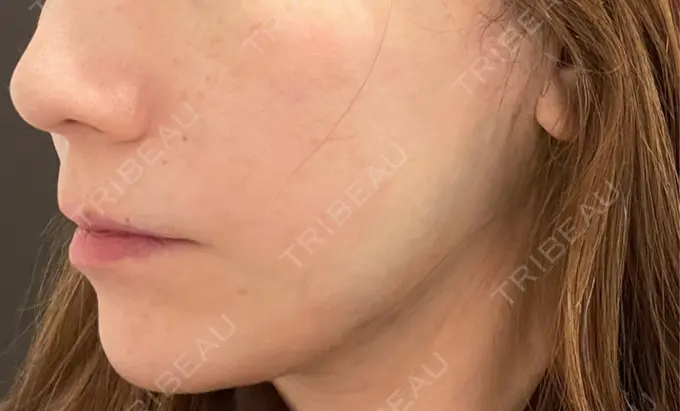 糸リフト / 脂肪吸引（顔） / ボトックス（エラ・小顔） RIVER CLINIC（リバークリニック） DAY 0 メイン用