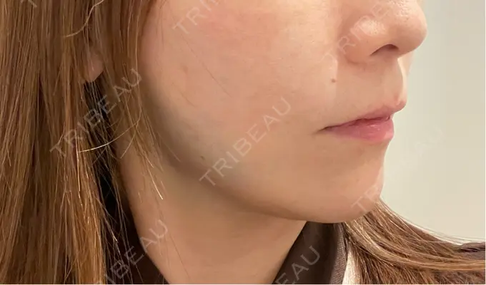 糸リフト / 脂肪吸引（顔） / ボトックス（エラ・小顔） RIVER CLINIC（リバークリニック） DAY 0 メイン用