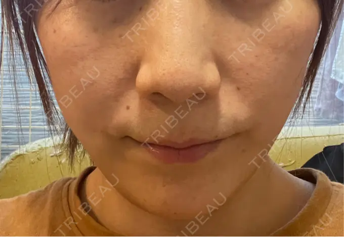 糸リフト / 脂肪吸引（顔） / ボトックス（エラ・小顔） RIVER CLINIC（リバークリニック） DAY 1 メイン用