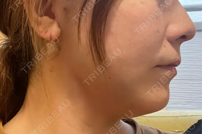 糸リフト / 脂肪吸引（顔） / ボトックス（エラ・小顔） RIVER CLINIC（リバークリニック） DAY 1 メイン用