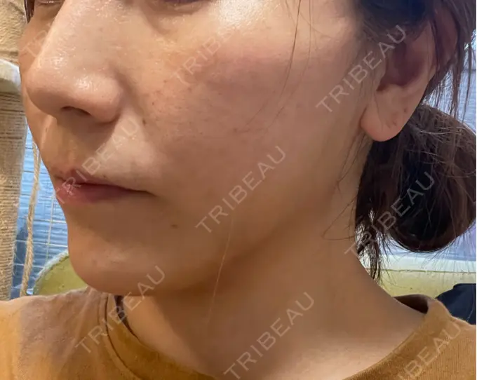 糸リフト / 脂肪吸引（顔） / ボトックス（エラ・小顔） RIVER CLINIC（リバークリニック） DAY 1 メイン用