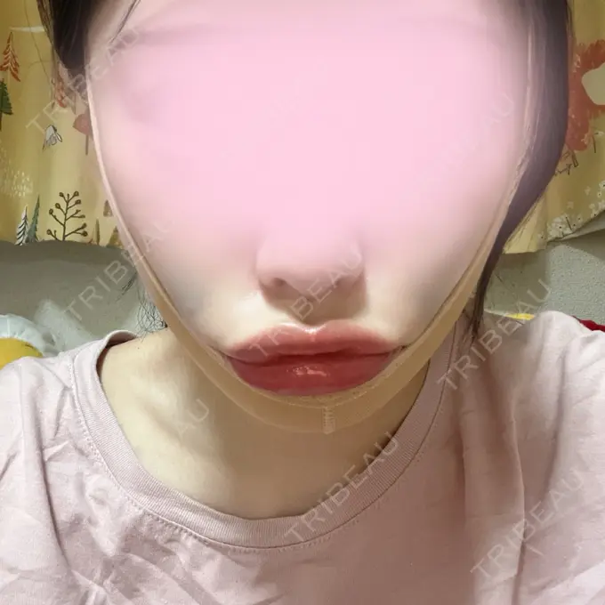 糸リフト / 脂肪吸引（顔） 東京ココセランクリニック DAY 4 メイン用