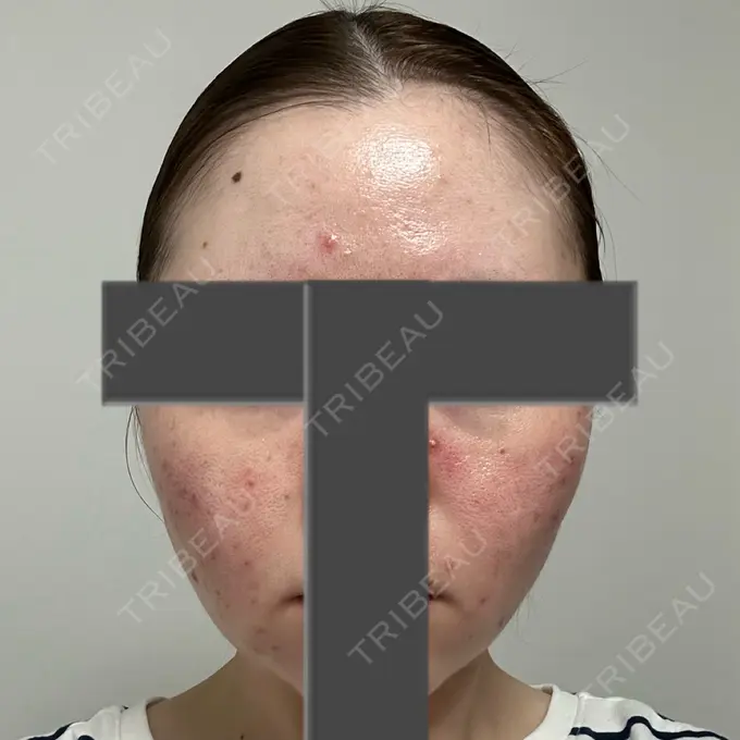 ニードルRF（ポテンツァなど） 東京美容外科 池袋院 AFTER メイン用