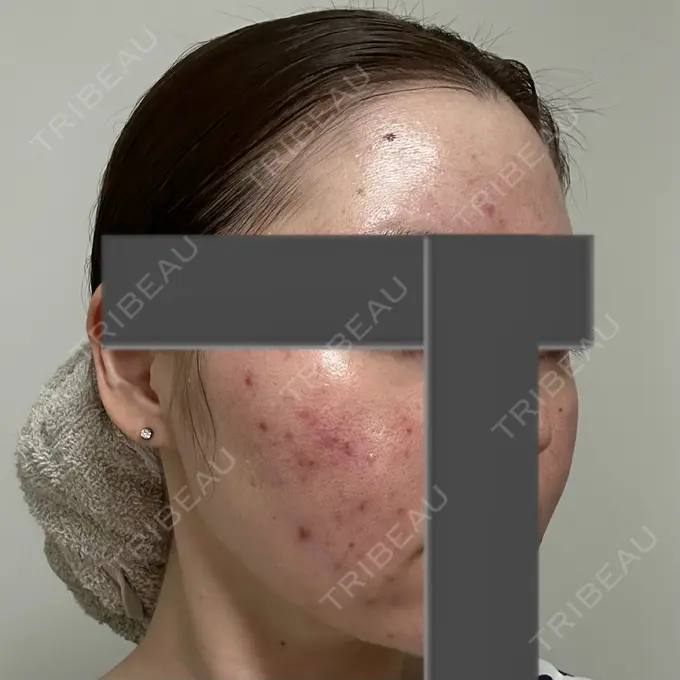 ニードルRF（ポテンツァなど） 東京美容外科 池袋院 DAY 36 メイン用