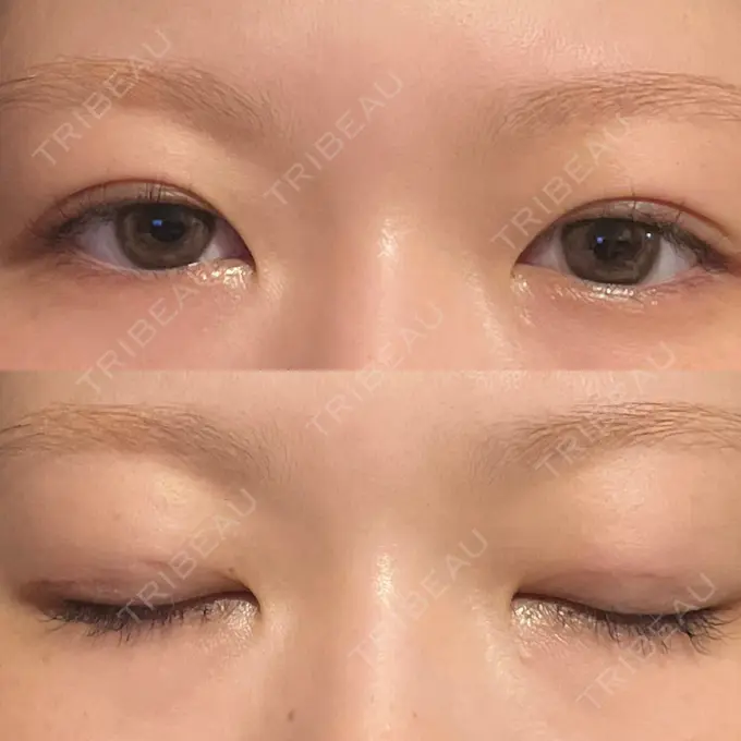 二重埋没 水の森美容クリニック 東京銀座院 AFTER メイン用