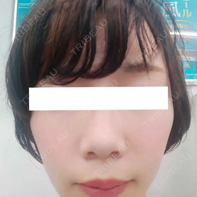 ハイフ（顔） / ハイフ（首） 銀座TSUBAKIクリニック DAY 1 メイン用