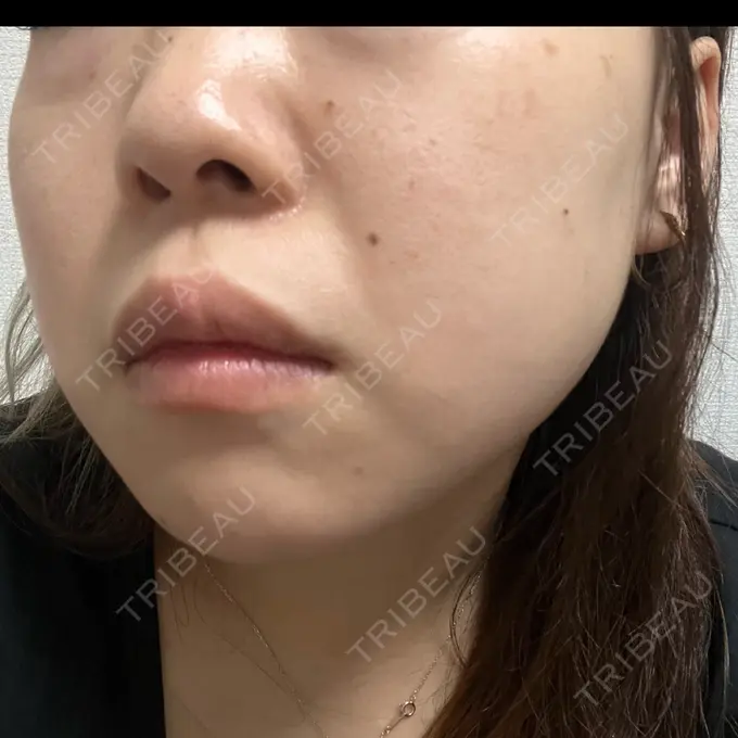 エレクトロポレーション / ルメッカ B-LINE CLINIC 池袋院 DAY 1 メイン用