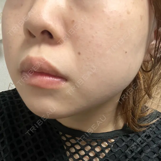 エレクトロポレーション / ルメッカ B-LINE CLINIC 池袋院 DAY 4 メイン用