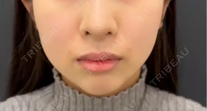 ヒアルロン酸注入（鼻翼基部） ルラ美容クリニック 広島院 AFTER メイン用