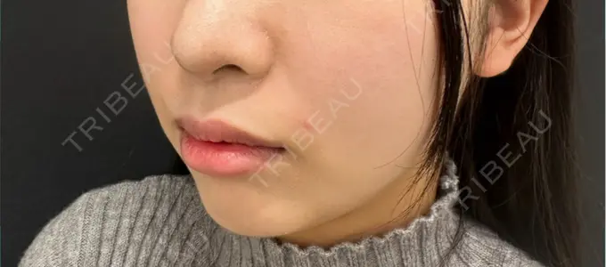 ヒアルロン酸注入（鼻翼基部） ルラ美容クリニック 広島院 DAY 0 メイン用