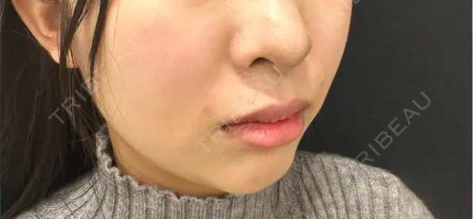 ヒアルロン酸注入（鼻翼基部） ルラ美容クリニック 広島院 DAY 0 メイン用