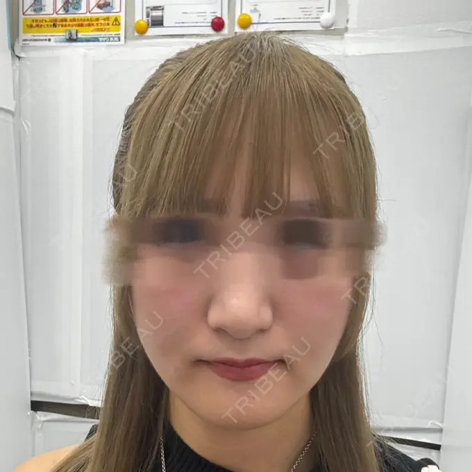 骨切り（あご） 銀座マイアミ美容外科 DAY 106 メイン用