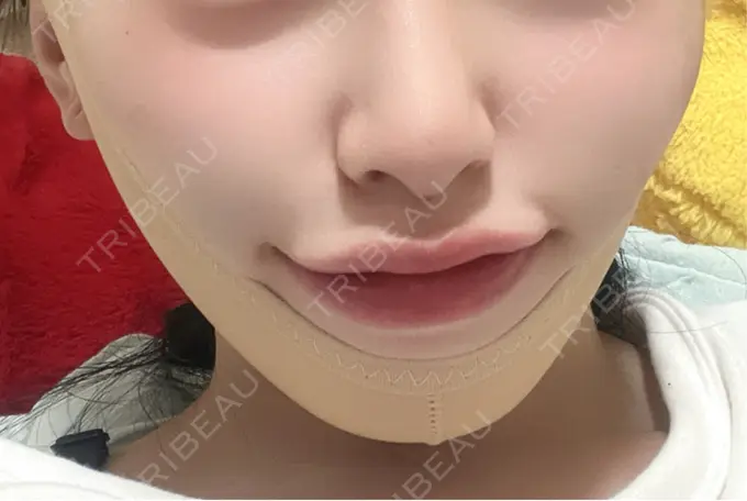 糸リフト / 脂肪吸引（顔） 東京ココセランクリニック DAY 5 メイン用