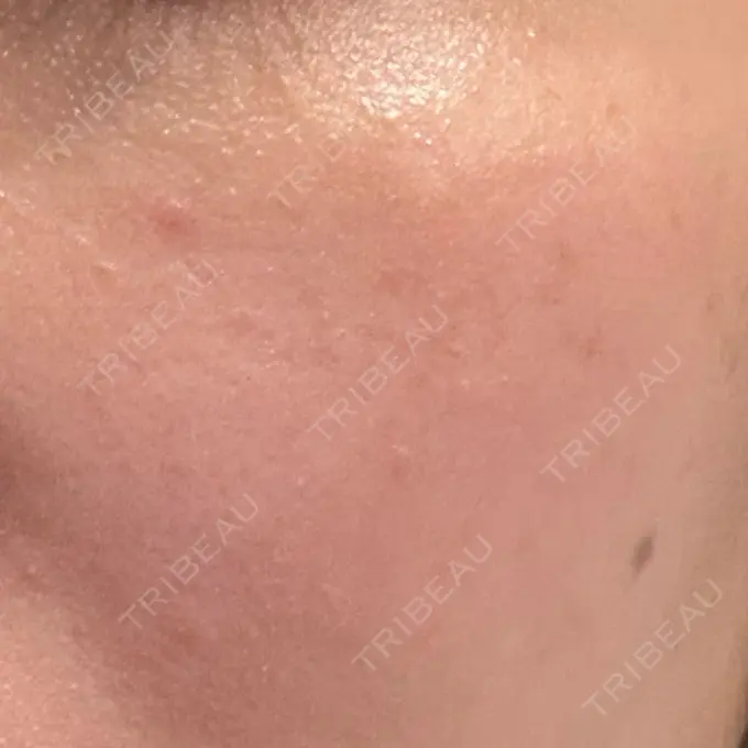 その他（肌） / 光治療（フォトフェイシャルなど） / フラクショナルレーザー（毛穴・ニキビ跡） オラクル美容皮膚科 名古屋院 DAY 2 メイン用