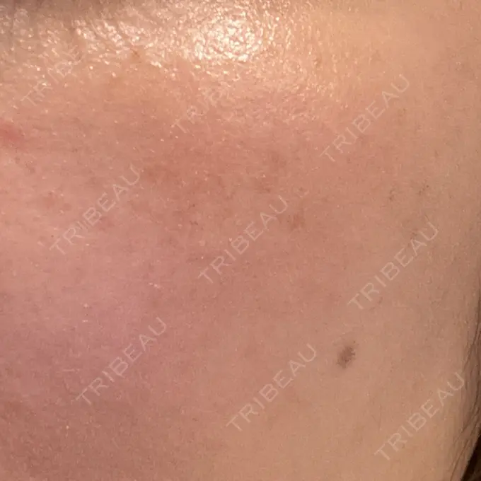 その他（肌） / 光治療（フォトフェイシャルなど） / フラクショナルレーザー（毛穴・ニキビ跡） オラクル美容皮膚科 名古屋院 DAY 6 メイン用