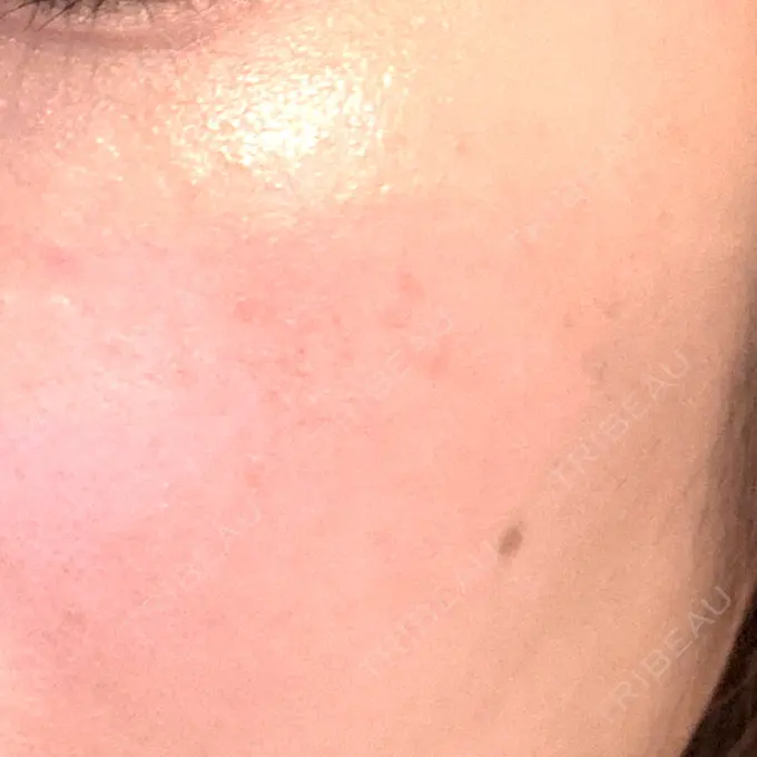 その他（肌） / 光治療（フォトフェイシャルなど） / フラクショナルレーザー（毛穴・ニキビ跡） オラクル美容皮膚科 名古屋院 AFTER メイン用