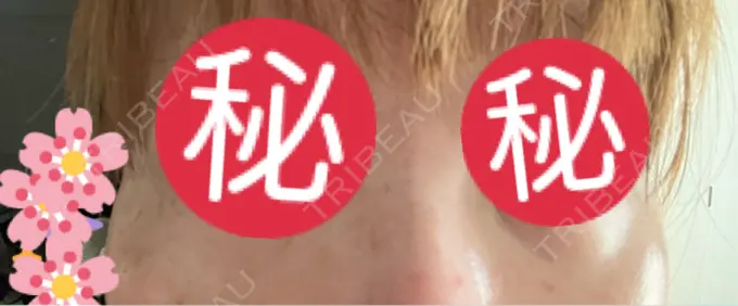 クマ治療 東京形成美容外科 船橋院 AFTER メイン用