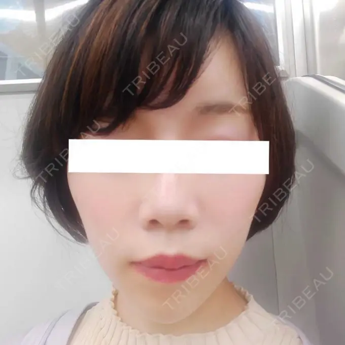 ハイフ（顔） / ハイフ（首） 銀座TSUBAKIクリニック AFTER メイン用