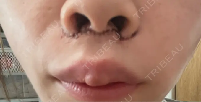 糸リフト / 人中短縮 / ジョールファット除去 吉祥寺アイビークリニック AFTER メイン用