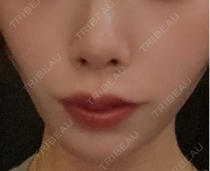 糸リフト / 人中短縮 / ジョールファット除去 吉祥寺アイビークリニック DAY 40 メイン用