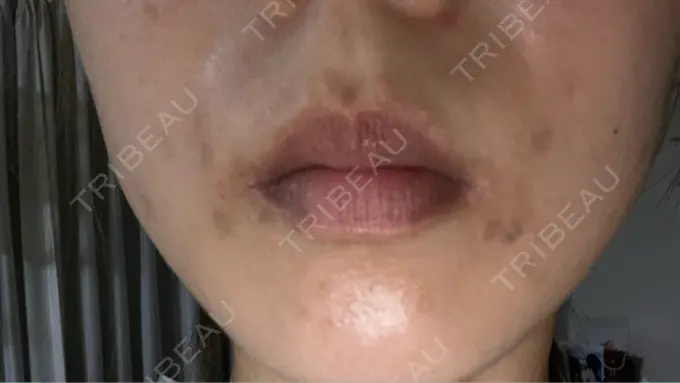 シミ取りレーザー S-Laboクリニック 渋谷院 AFTER メイン用