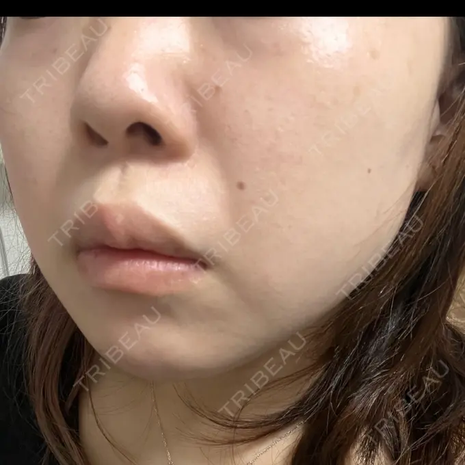 エレクトロポレーション / ルメッカ B-LINE CLINIC 池袋院 DAY 6 メイン用