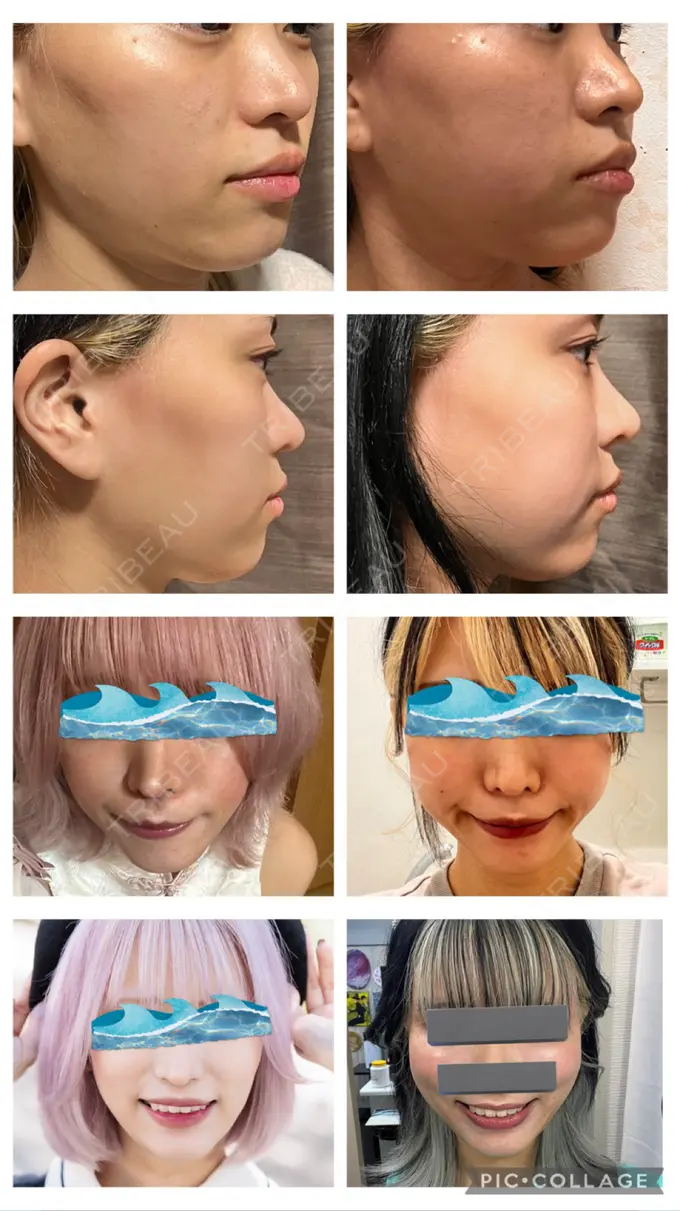 クマ治療 / 脂肪注入（額） / 脂肪注入（輪郭） X CLINIC 名古屋院 DAY 77 メイン用