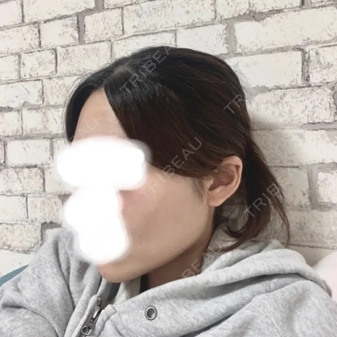 骨切り（あご） / 骨削り（エラ） / 骨削り（頬） id（アイディ）美容外科 AFTER メイン用