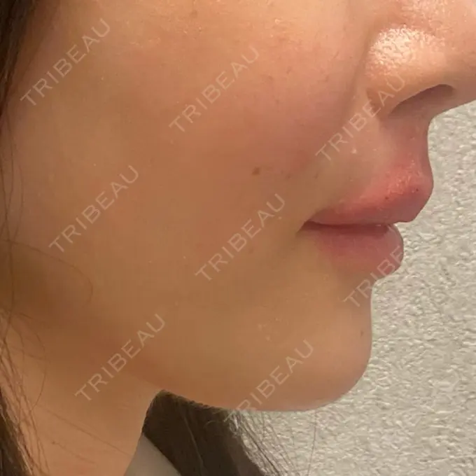 肌ヒアルロン酸注入（たるみ・シワ改善） / ヒアルロン酸注入（唇） BiBiクリニック DAY 0 メイン用