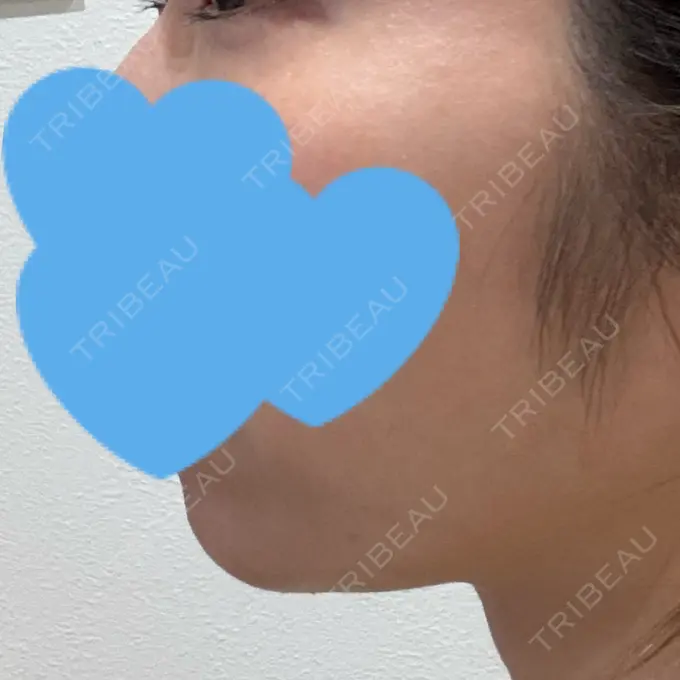 ハイフ（顔） / エレクトロポレーション ちぐさ内科クリニック 覚王山 AFTER メイン用