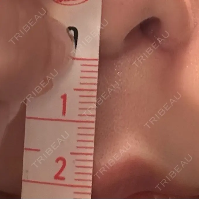 小鼻縮小（切開） / 人中短縮 eクリニック 東京院 DAY 34 メイン用