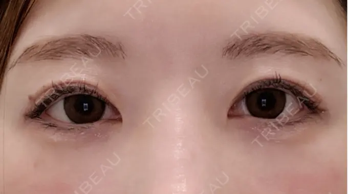 眼瞼下垂（非切開） SOL CLINIC DAY 12 メイン用